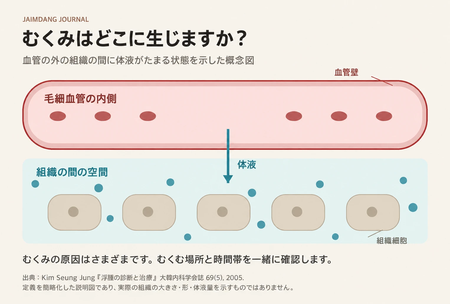 むくみのメカニズム説明図：毛細血管外の組織間に体液がたまる状態