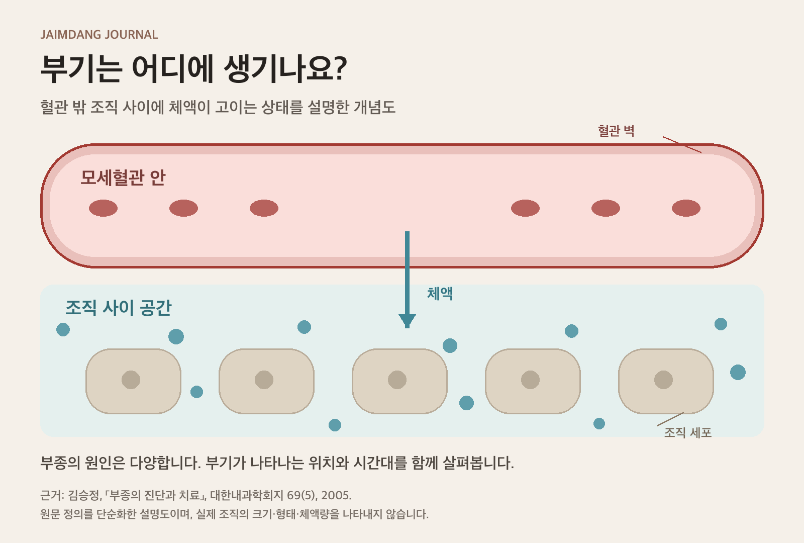부종의 기전 설명도: 모세혈관 밖 조직 사이에 체액이 고이는 상태